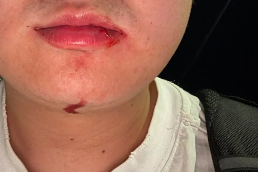 一名身穿白衣的男子嘴角和下巴都在流血。