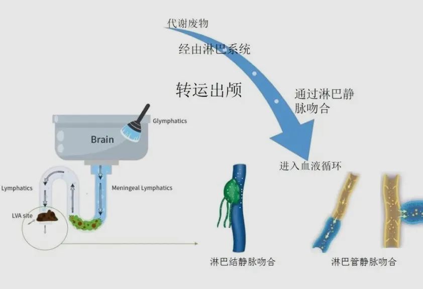 杭州求是医院LVA手术治疗阿尔茨海默病的手术原理