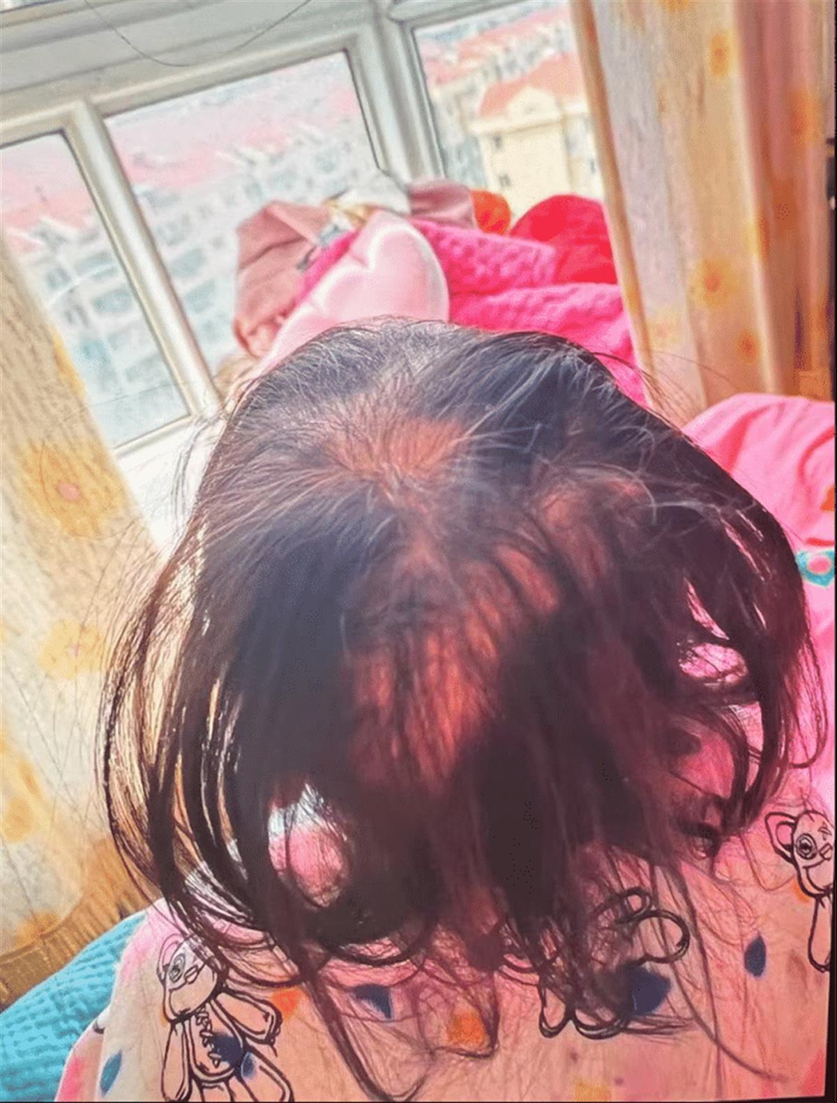 女孩大把脱发（图源：潇湘晨报）