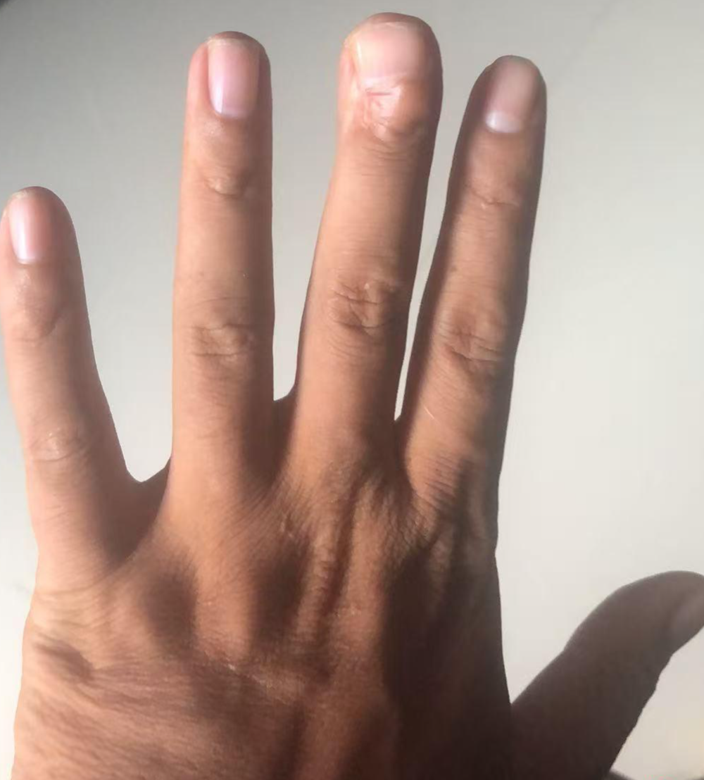 ▲蔡斌手指上的伤疤