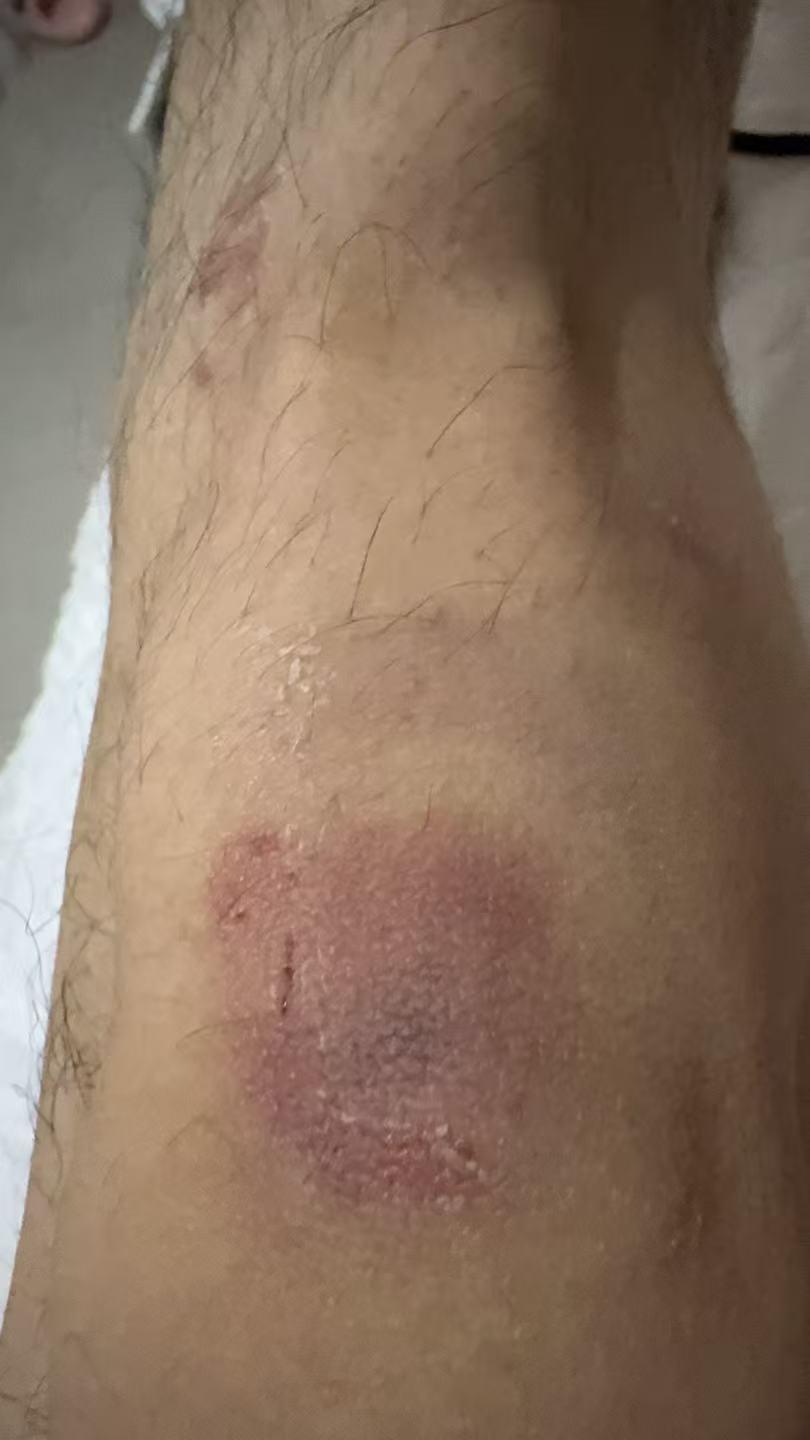 ▲蒋某某腿部有淤青 受访者供图