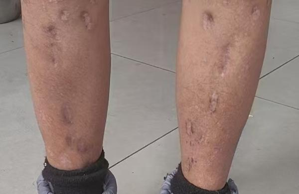 戴浩腿上术后留下的疤痕 (受访者提供)