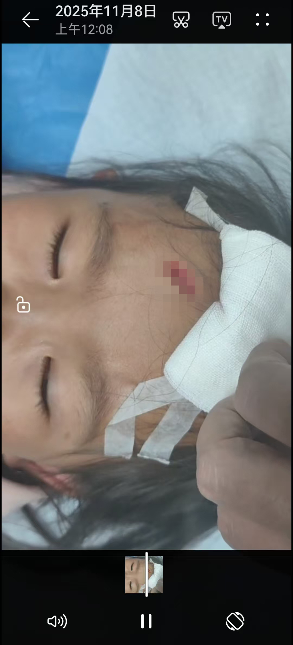 孩子额头的伤口总长度cm