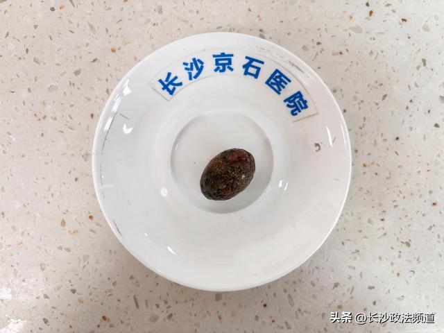 刘女士经保胆手术取出的一枚“小牛油果”结石