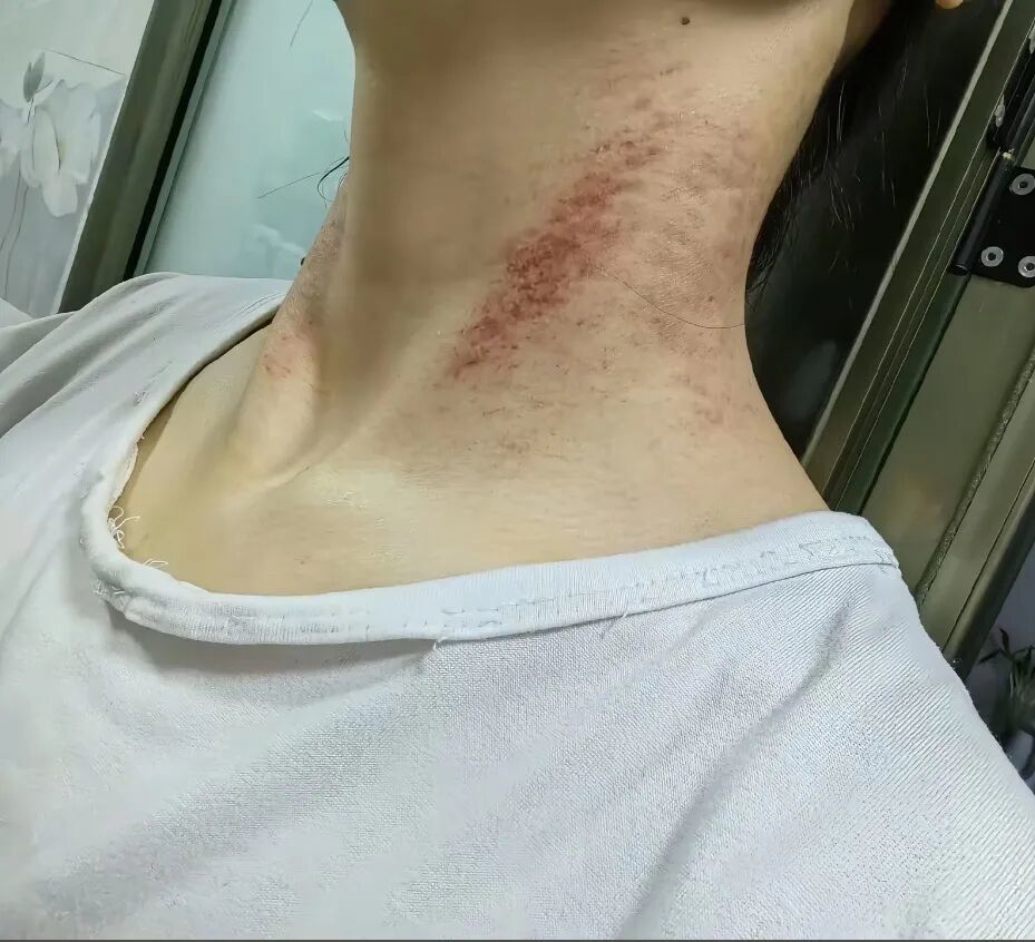 董文卉脖子上的伤痕
