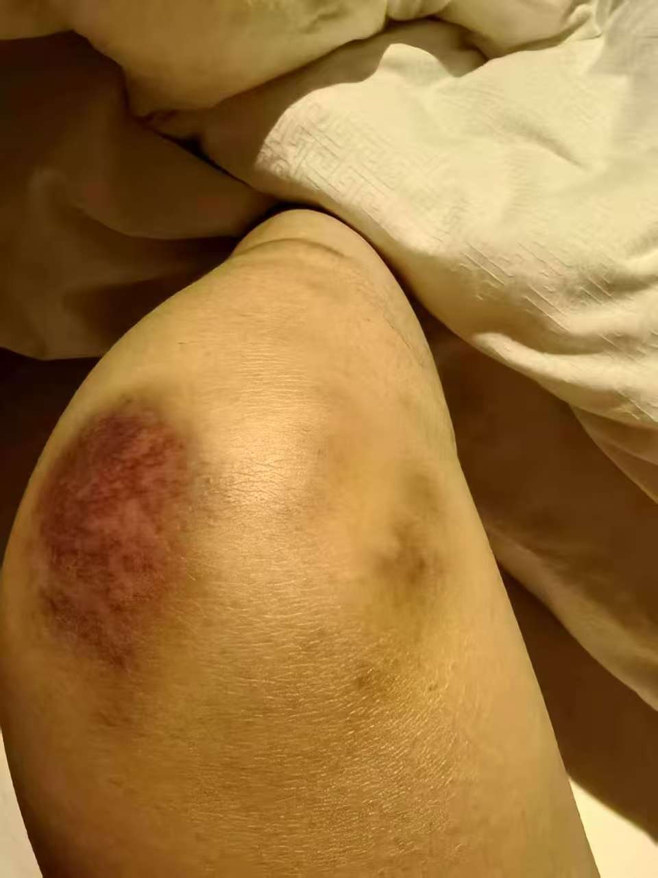 黄飞飞提供的被家暴留下的淤青照片。受访者供图