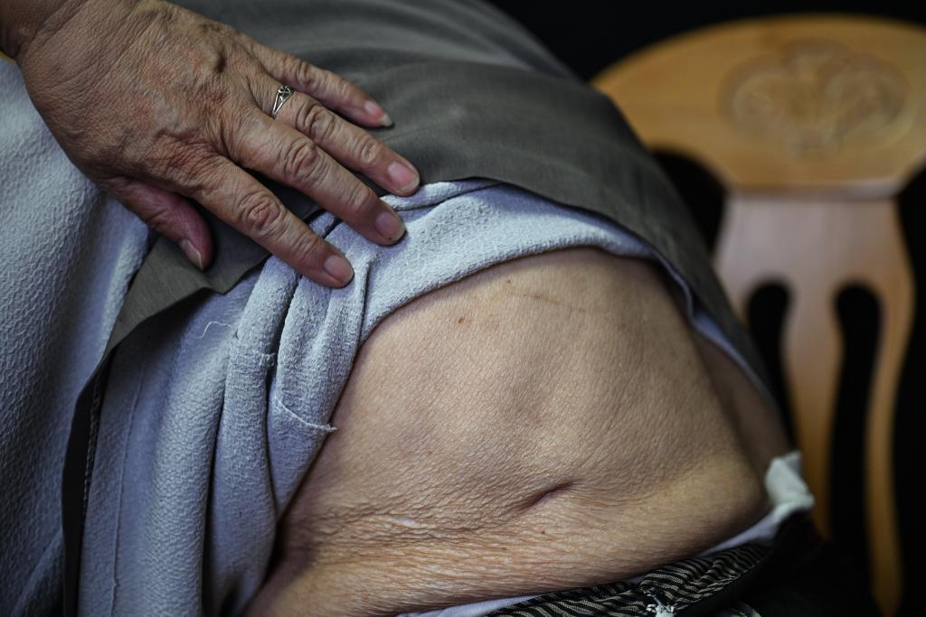 ↑2025年5月21日，夏淑琴展示自己身上的刀疤。