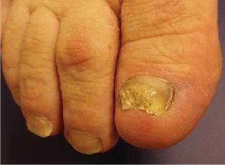 指甲月牙小、有竖纹就是不健康吗！这些真相 一定要知道