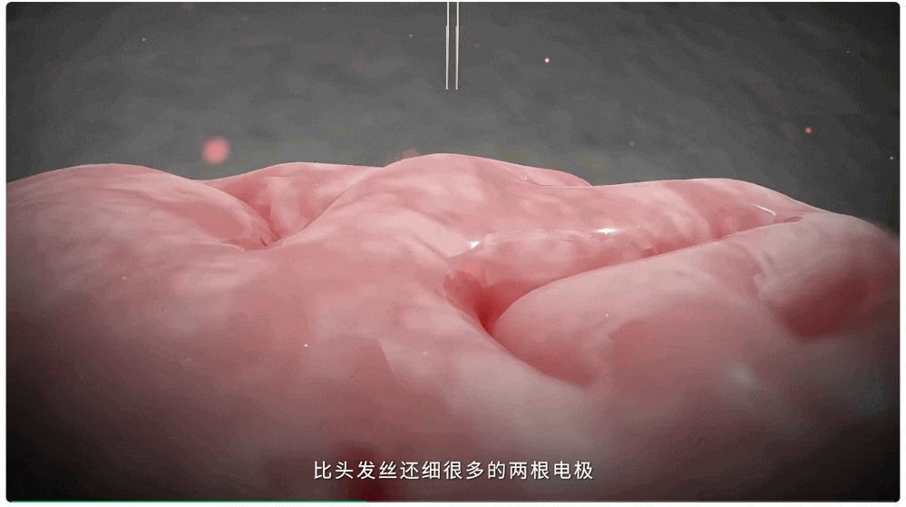 比马斯克Neuralink工艺更先进!中国成功开展首例侵入式脑机接口临床试验