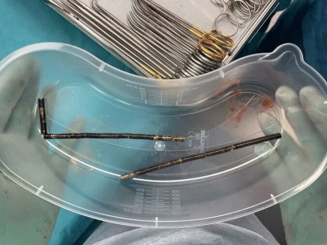 手术取出的强磁铁 | Lekamalage et al., NZMJ, 2025