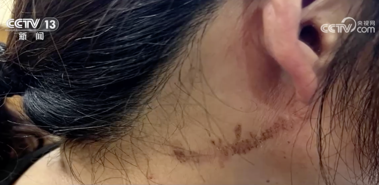 △拍打隱翅蟲后留下的疤