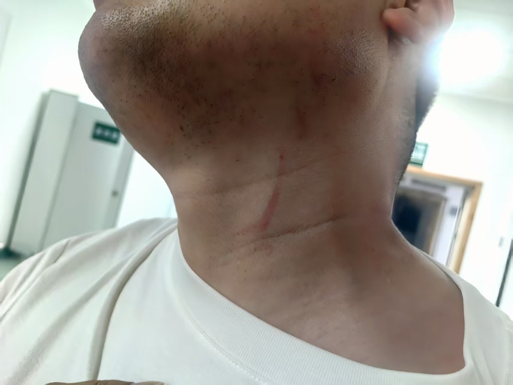李飞颈部抓痕