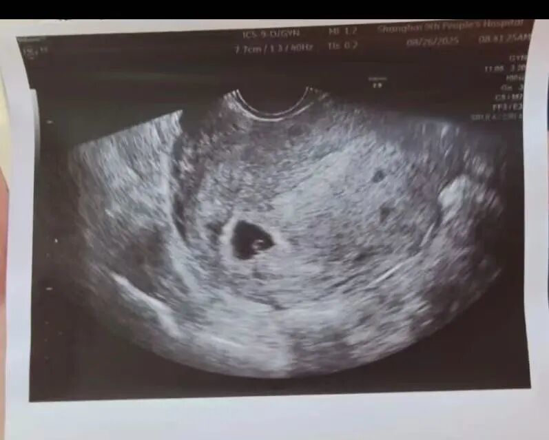 小魏腹中宝宝的人生第一张照片