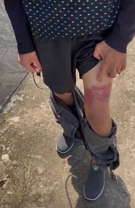 陈平在展示自己做工时腿上受的伤。 杨书源 摄