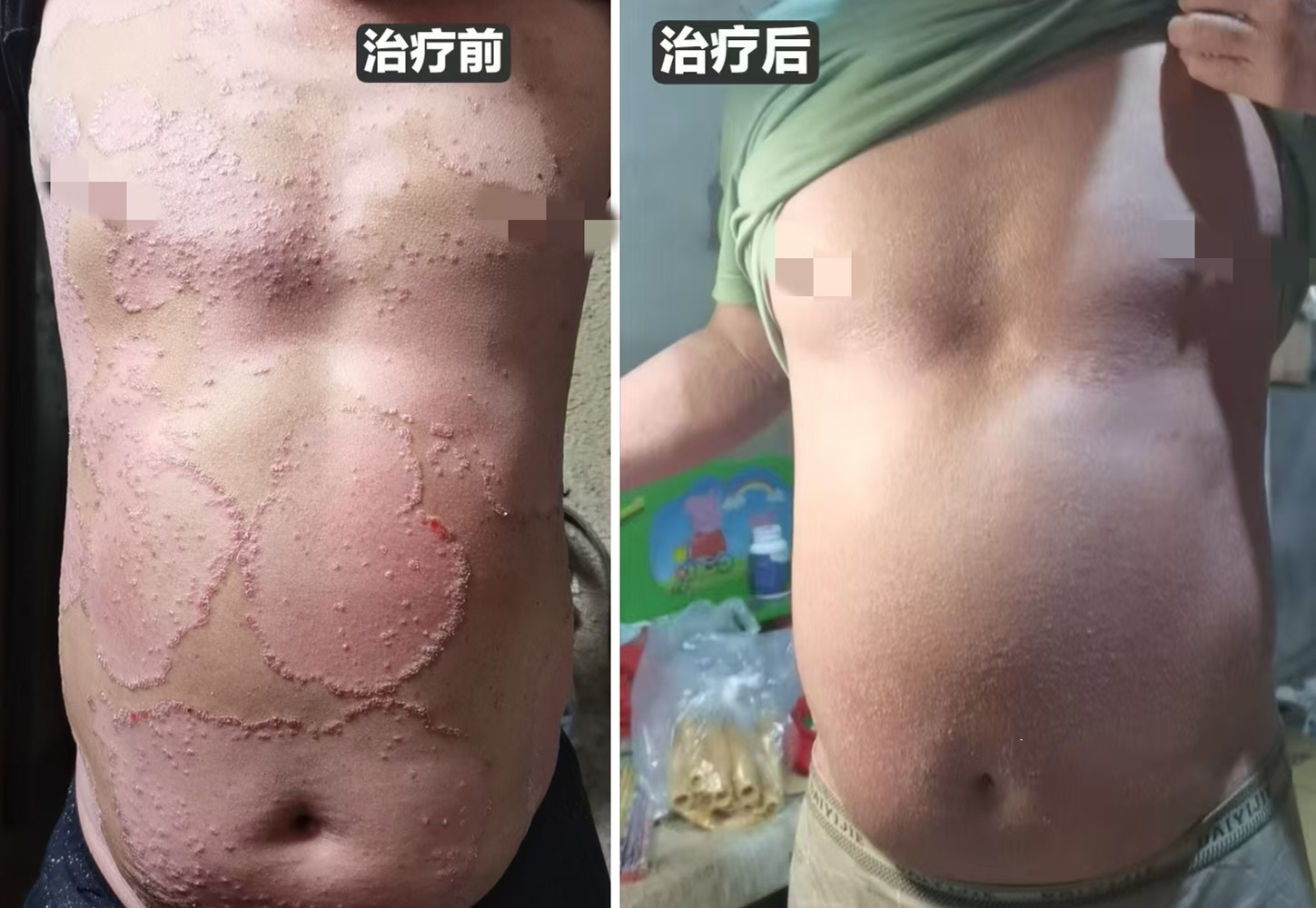 皮损对比.jpg