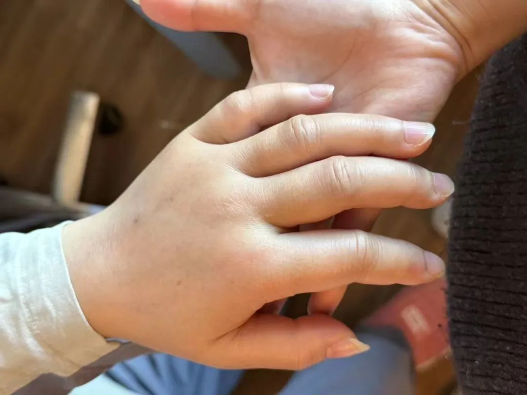 ◎ 彭佳妈妈的手因为输液严重水肿