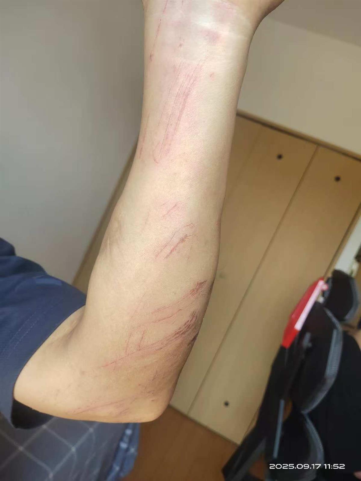 杨先生手臂被擦伤（图源：受访者）
