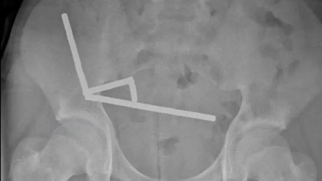 男孩的腹部X光片 | Lekamalage et al., NZMJ, 2025