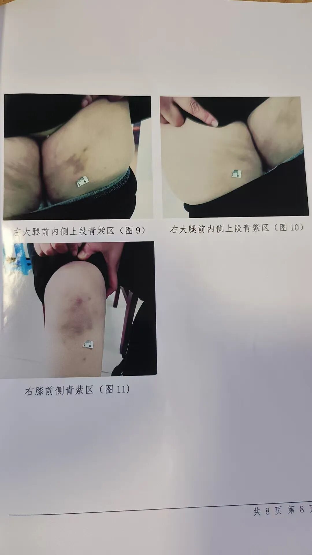 商文娟的伤情照片。(图/受访者提供)