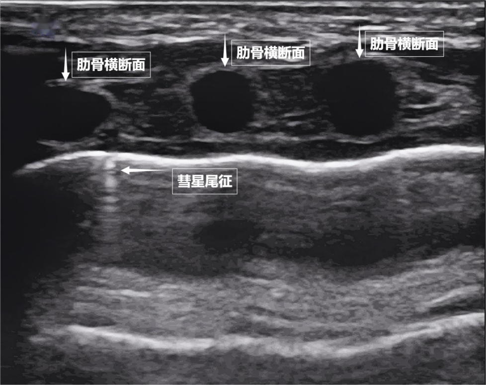 图为正常新生儿肺部超声表现