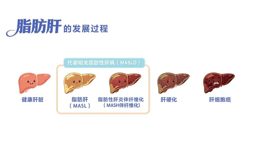 “减重针”司美格鲁肽开始治脂肪肝,哪些人需要打?