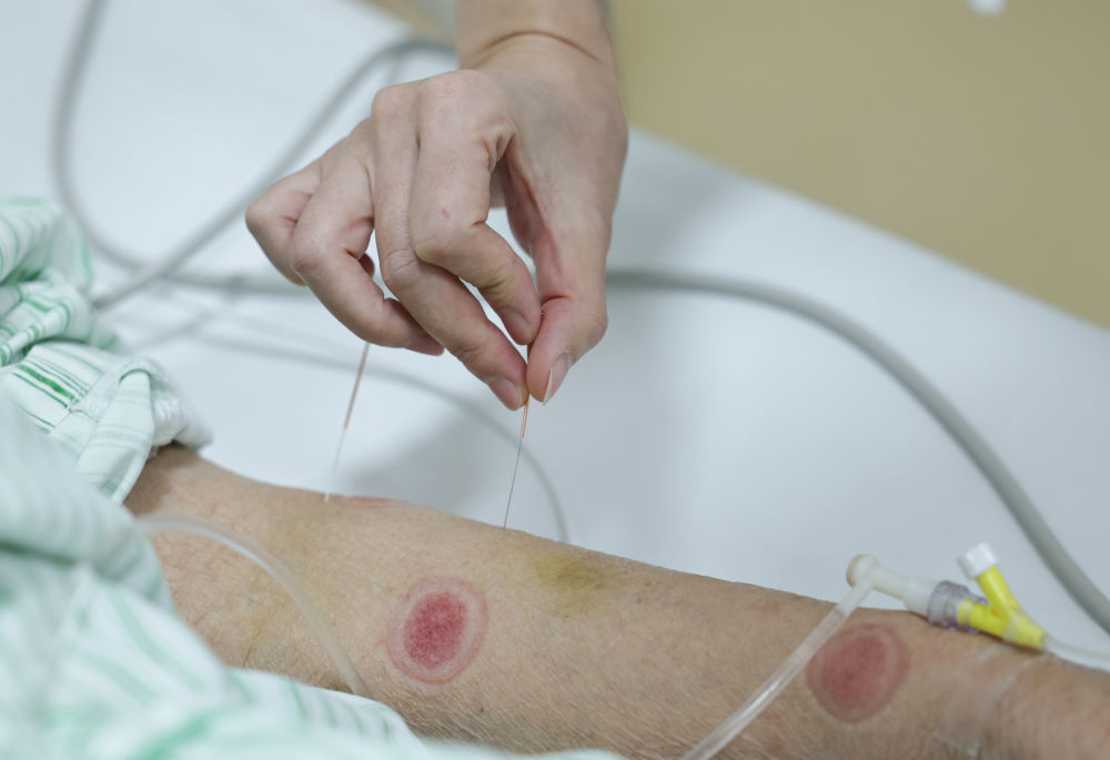 2月9日9时许，急诊科主治医师李琼为住院病人进行针灸治疗。