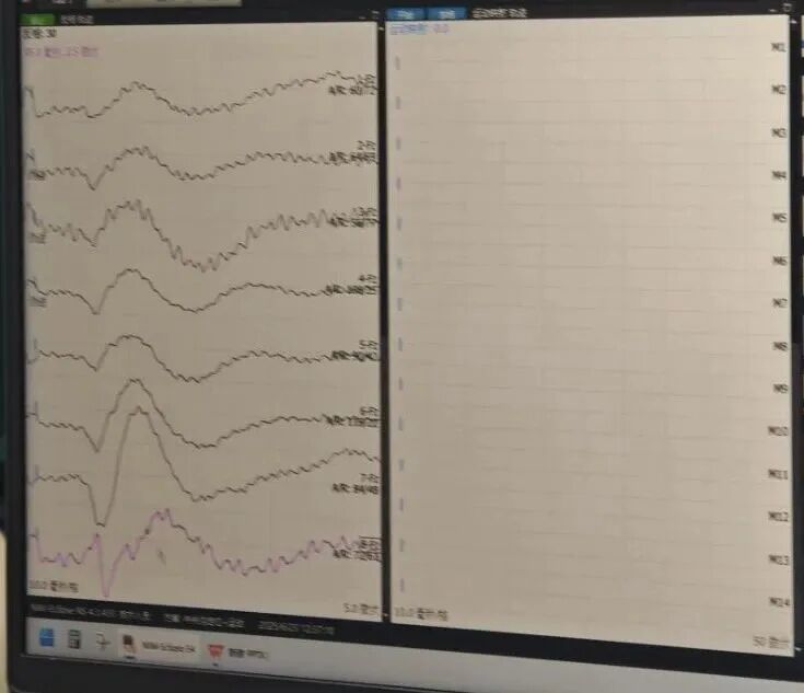 2025年,全国多地12家医院启动NEO脑机接口临床试验,图为试验关系的术中电生理检测图。 / 图源:复旦大学附属华山医院福建医院