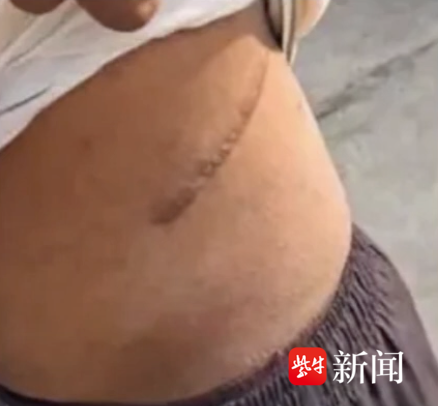 希曼舒· 德瓦杰手术后留下的疤痕