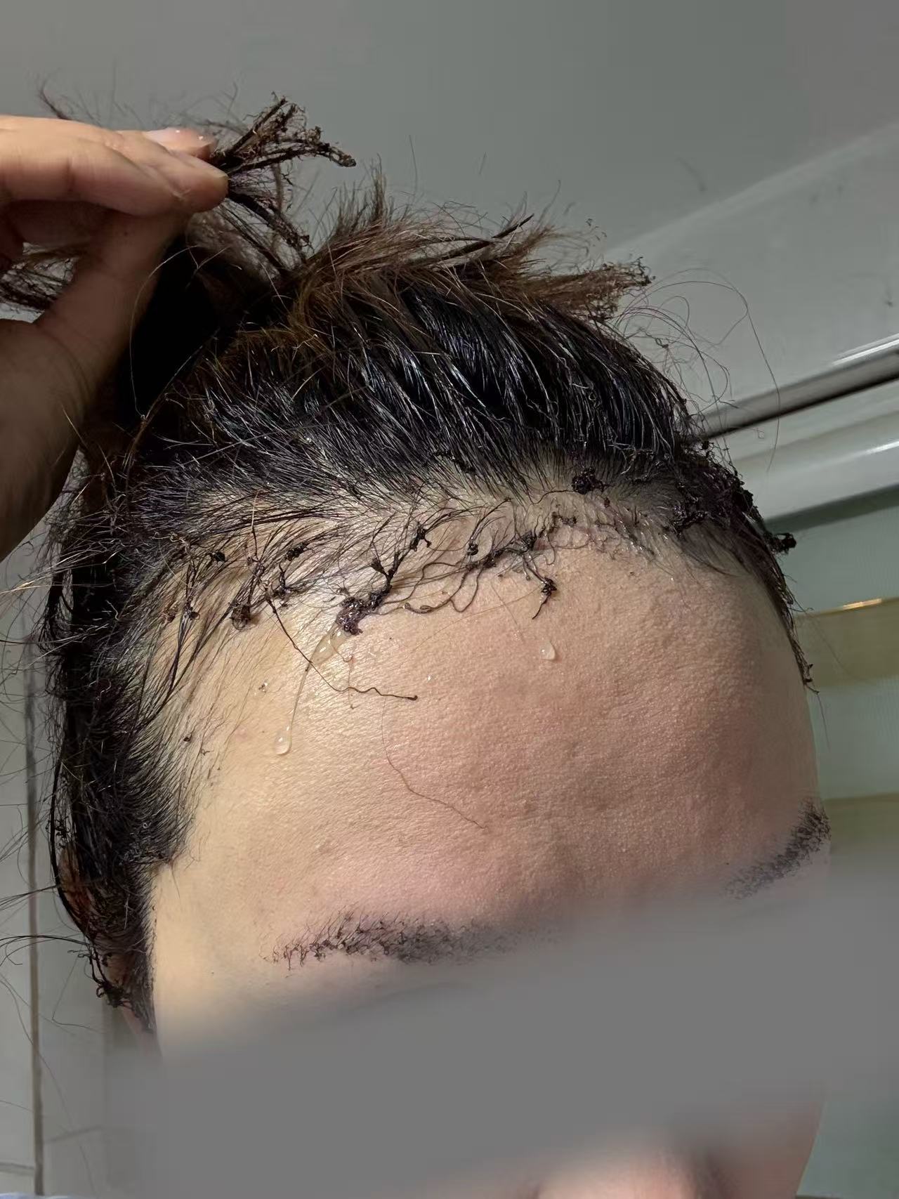▲殷女士头发眉毛均被烧焦。