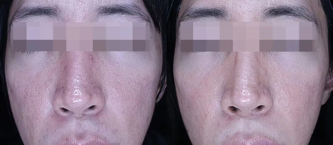 Re2O 治疗(间隔一个月,共 3 次)的患者真实对比图