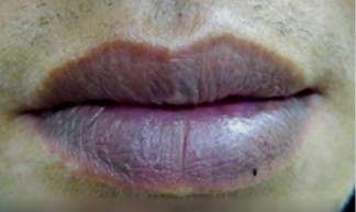 嘴唇发紫就是心脏不好吗 更重要的是看这一点