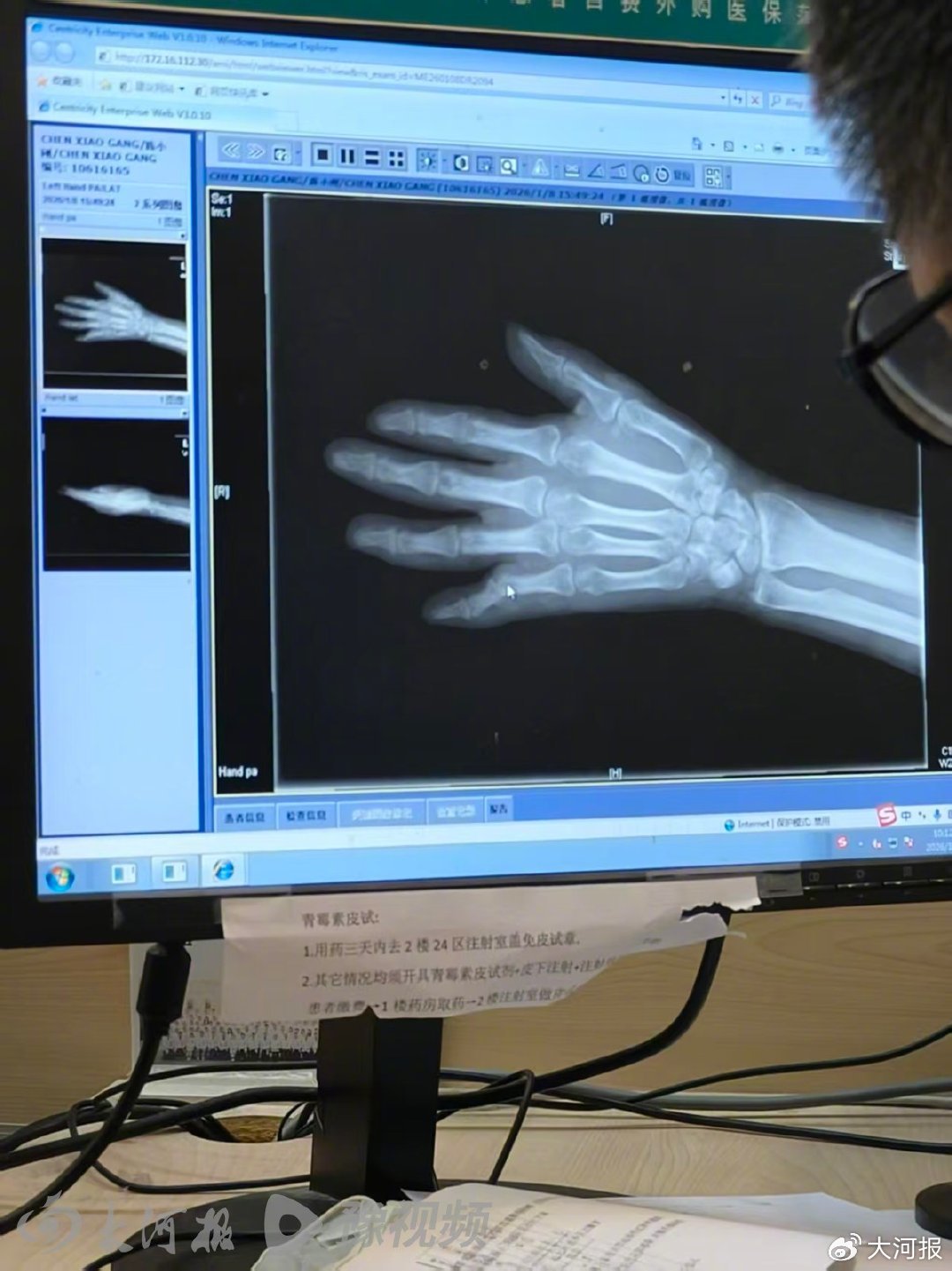 加油枪喷油致男子严重烧伤,加油站称不存在任何过错