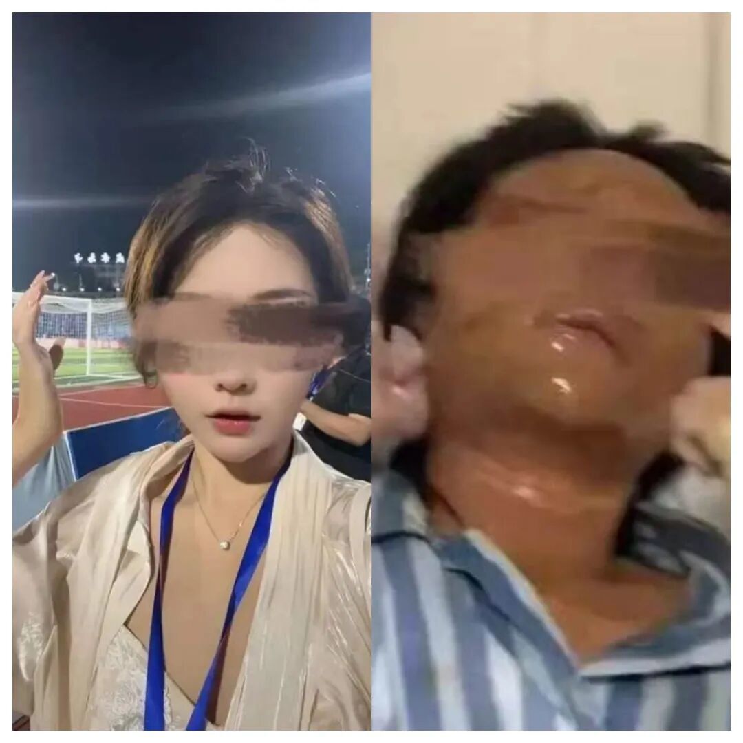 左图为思思被炸伤前，右图为她在医院接受治疗。图片来源/受访者
