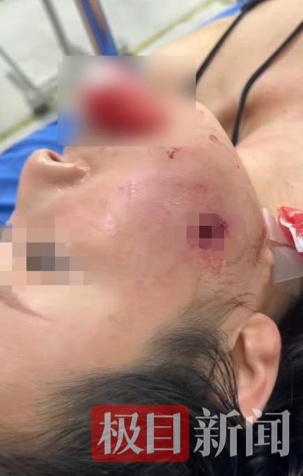 冯女士母亲脸部留下弹孔
