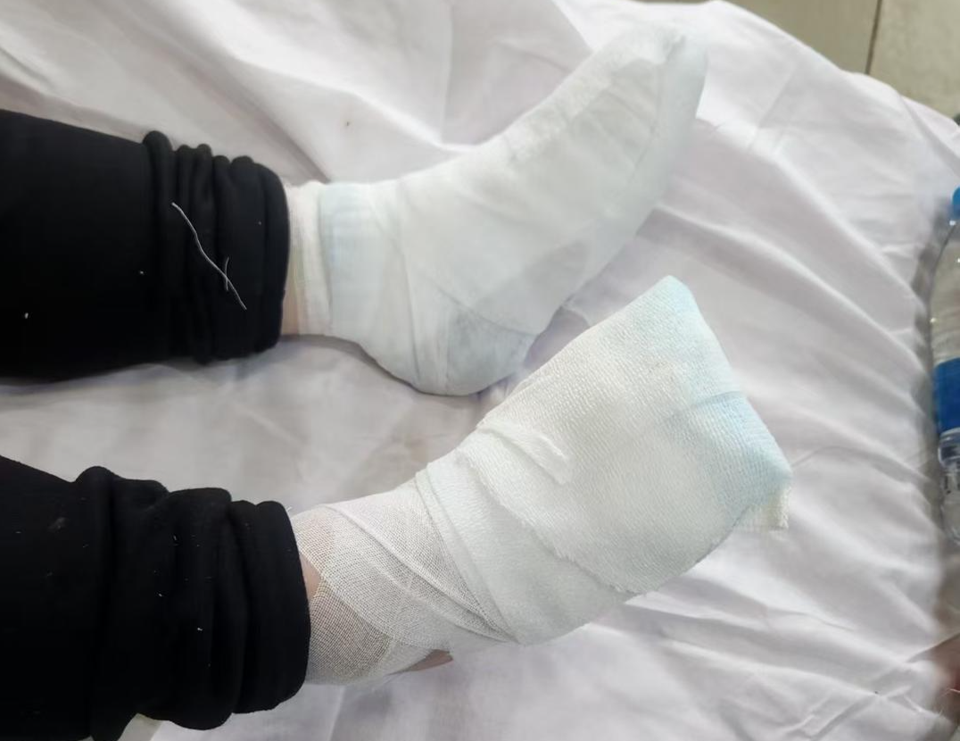 ▲小陈的双脚被冻伤