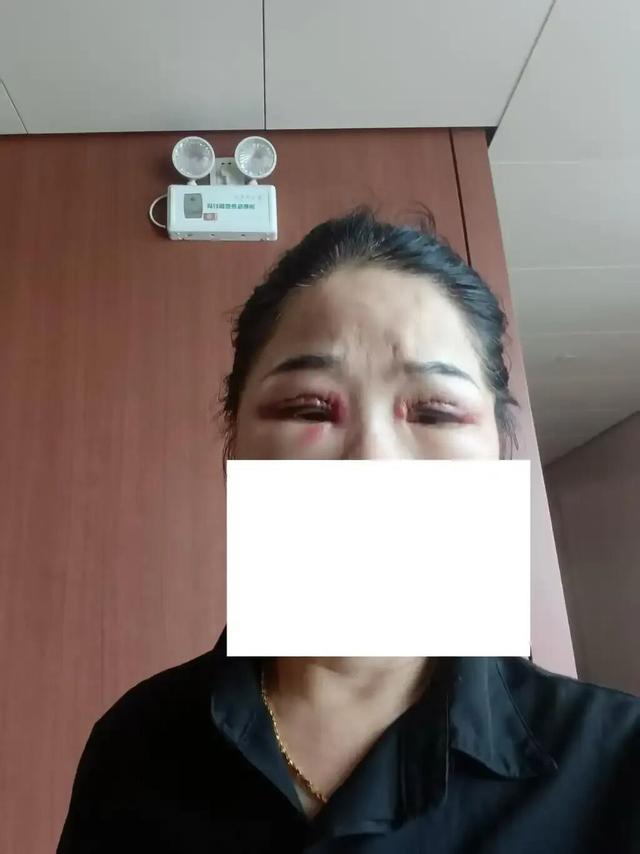 郑大姐术后双眼红肿明显