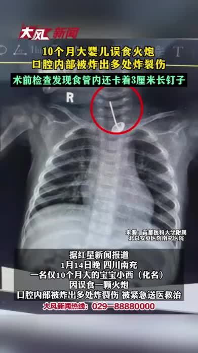10个月大婴儿误食火炮回腔内部被炸出多处炸裂伤术前检查发现食管内还卡着3厘米长钉子