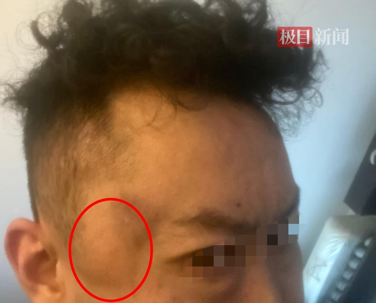 男子太阳穴处被打(受访者供图)