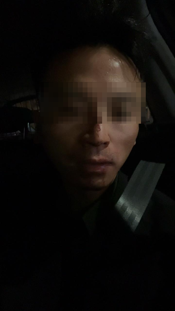 ▲郑家兴鼻梁骨折