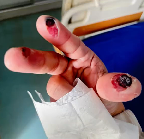 俗称“化骨水”、腐蚀性极强！日本一研究生遭氢氟酸淋头后死亡