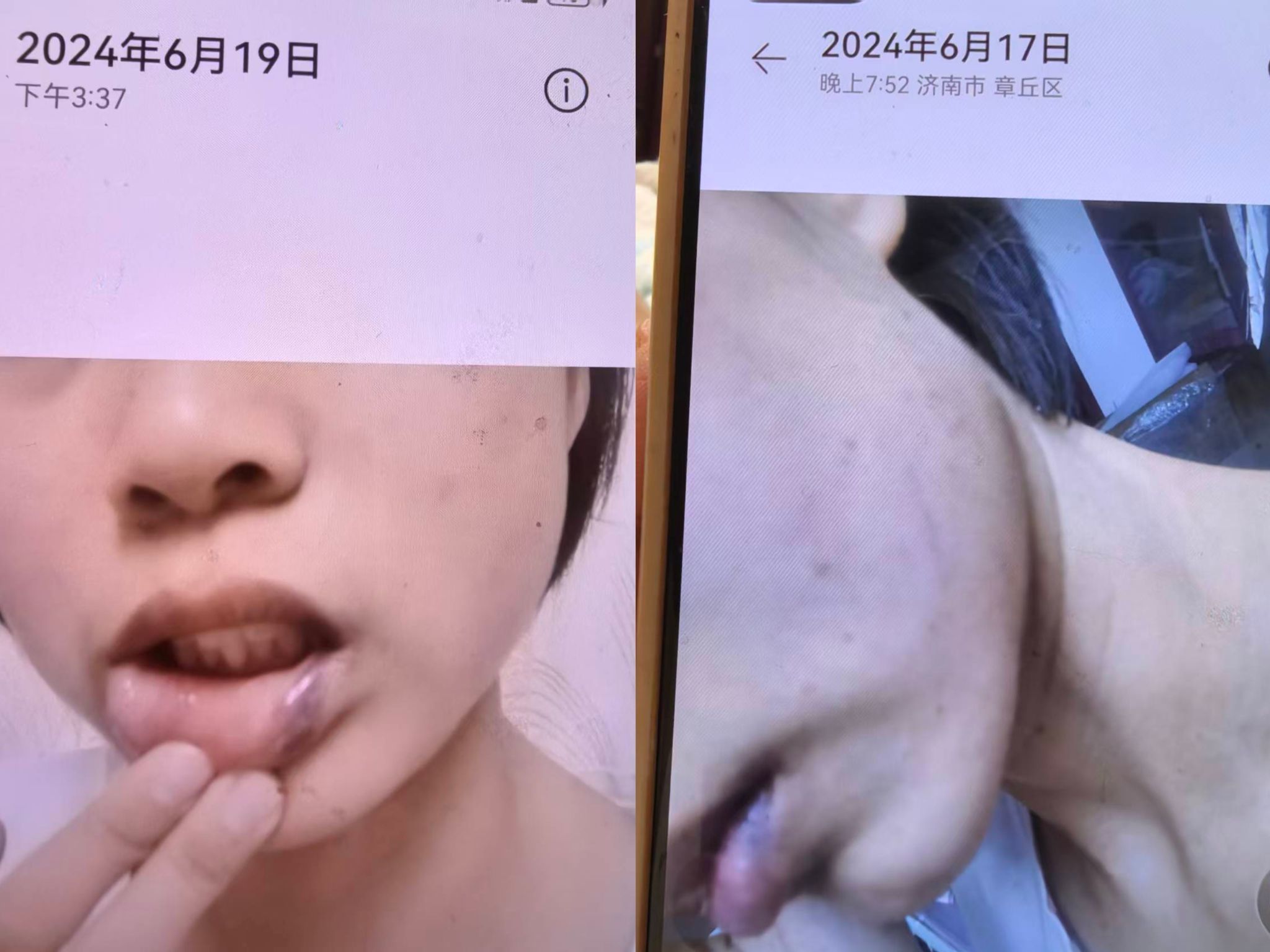 △丹丹被打后嘴唇乌青。