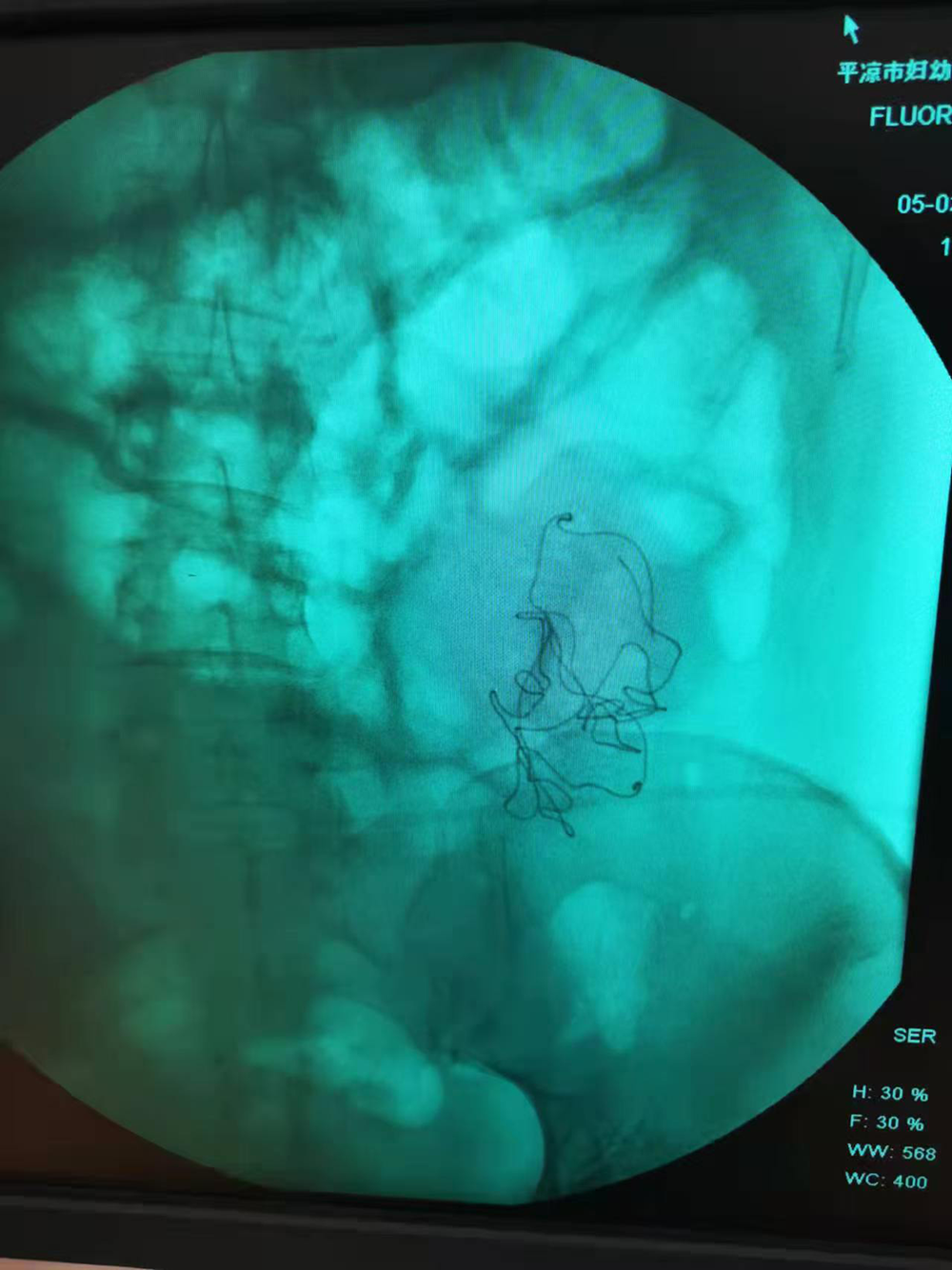 秦红利分娩后,进行X光检查发现异物清晰可见。本文图片均为 受访者供图