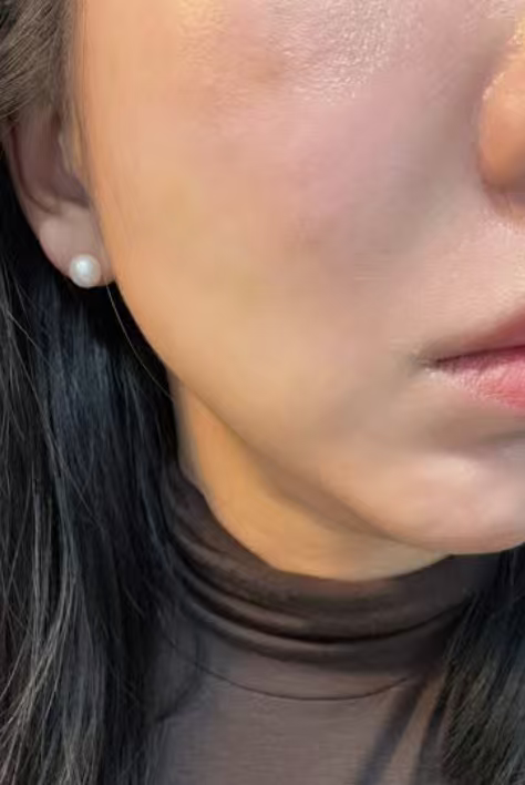 打完Re2O的林悦(化名)。(图源受访者)