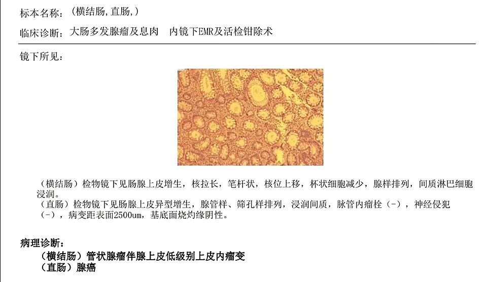 4月1日林灵收到的病理检测结果，显示为直肠癌。图/受访者提供