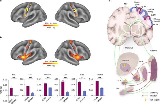 中国科学家世界首次发现帕金森病底层功能网络机制