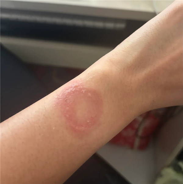 苹果Apple Watch灼伤手腕!更痛的是心寒:维权半年处处碰壁