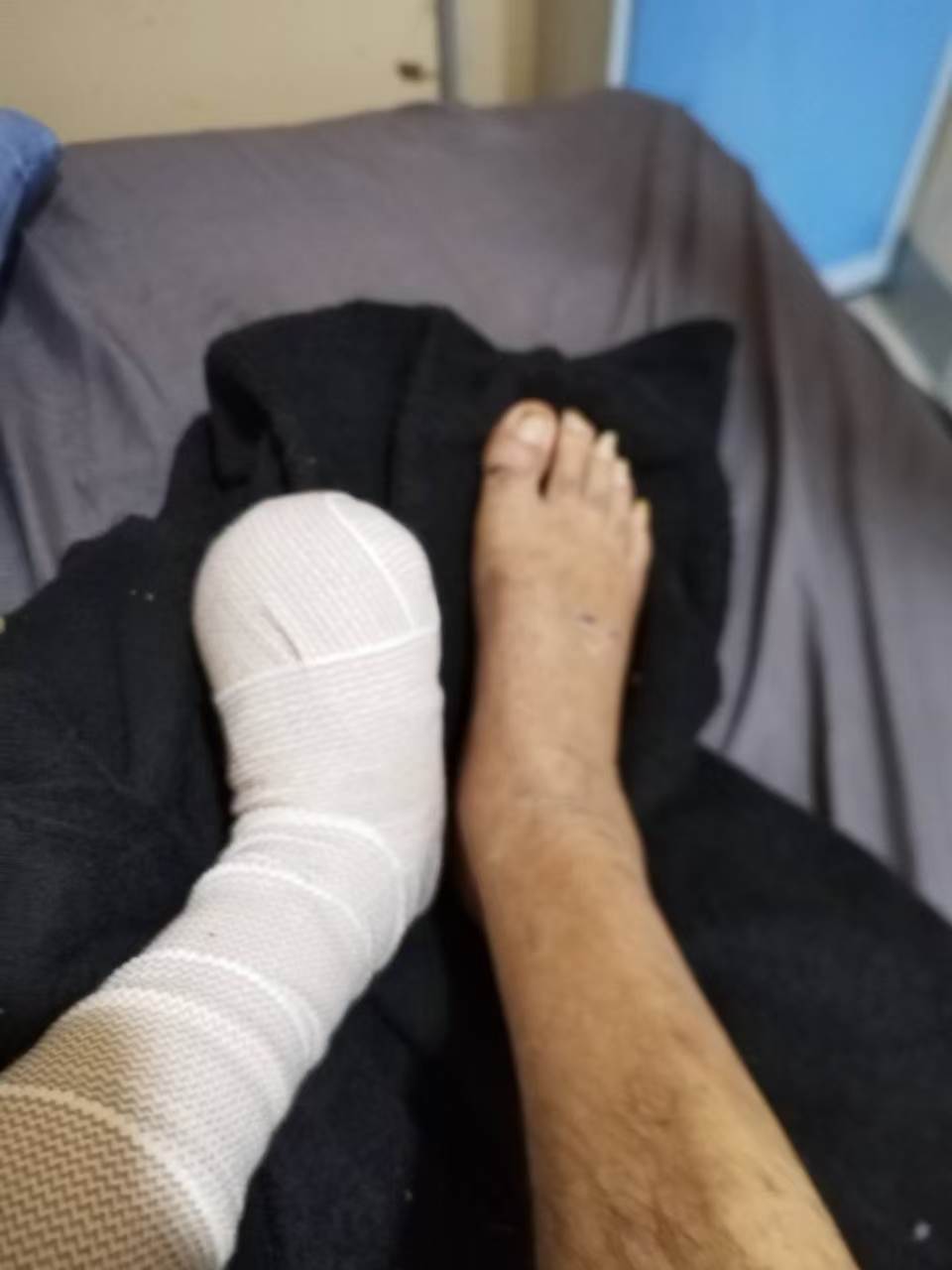 ▲陈路因糖尿病做了截肢手术,被羁押期间脚上仍包着纱布(受访者供图)
