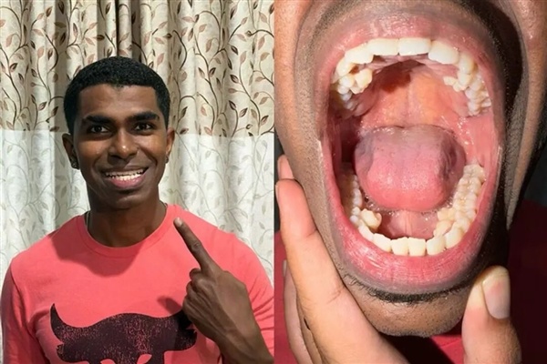 世界首例！印度少年上眼皮长出牙齿：医生直呼活久见