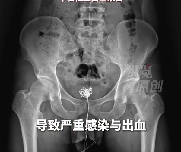 28岁男人兴趣心太强：塞25厘米数据线进尿谈拔不出