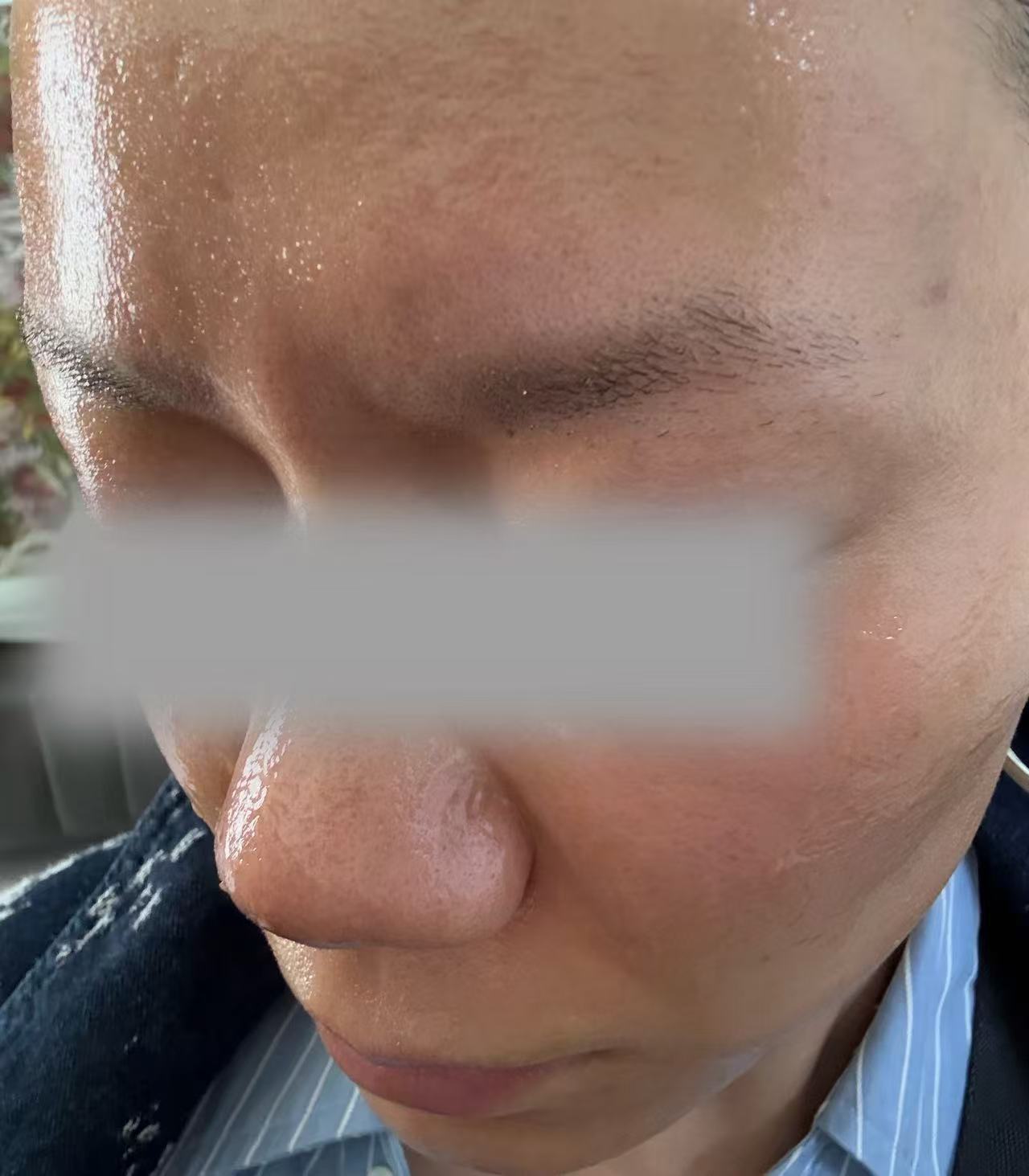 ▲殷女士处理后面部出现泛红。